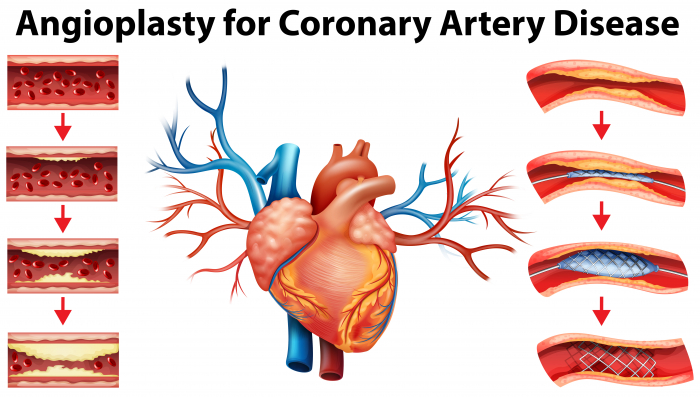 image of heart disease and stent